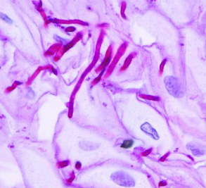 Soor-Ösophagitis
